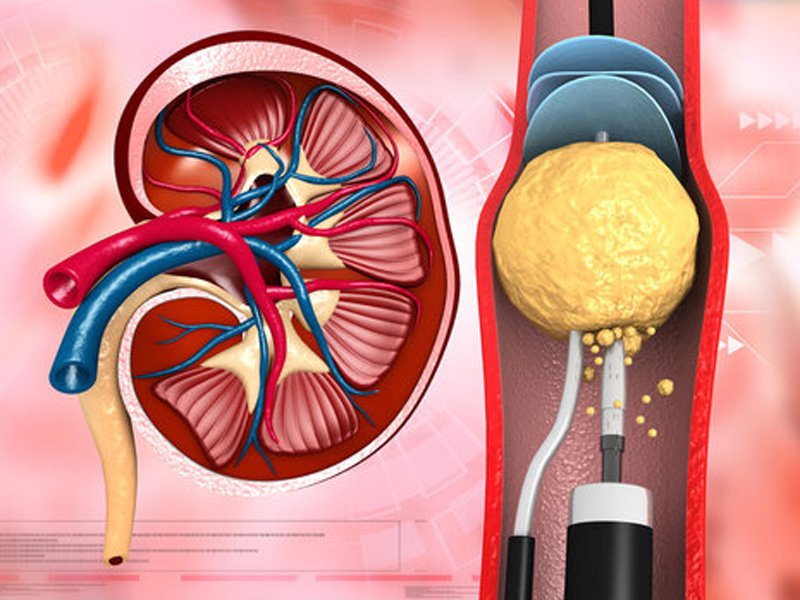 Kidney Stone Laser Treatment